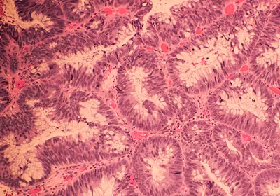 Pink- and purple-stained cells clustered into glands